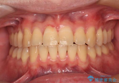 【モニター】前歯のデコボコとクロスバイト　ワイヤー矯正で短期間に仕上げるの症例 治療後