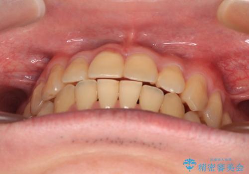 【モニター】前歯のデコボコとクロスバイト ワイヤー矯正で短期間に仕上げるの治療後
