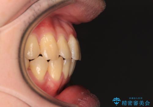 【モニター】前歯のデコボコとクロスバイト ワイヤー矯正で短期間に仕上げるの治療後