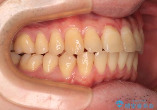 【モニター】前歯のデコボコとクロスバイト ワイヤー矯正で短期間に仕上げるの治療後