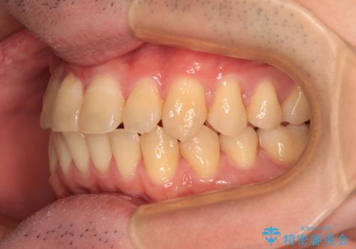 【モニター】前歯のデコボコとクロスバイト ワイヤー矯正で短期間に仕上げるの治療後