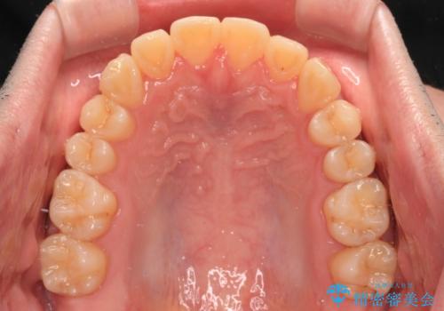 【モニター】前歯のデコボコとクロスバイト ワイヤー矯正で短期間に仕上げるの治療後
