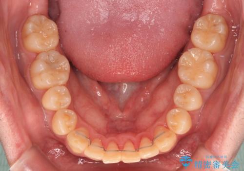 【モニター】前歯のデコボコとクロスバイト ワイヤー矯正で短期間に仕上げるの治療後