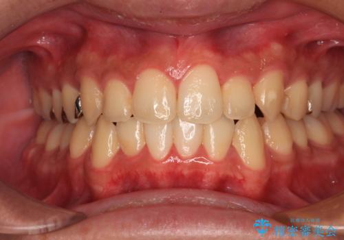 前歯のクロスバイト インビザラインによる矯正治療の治療後