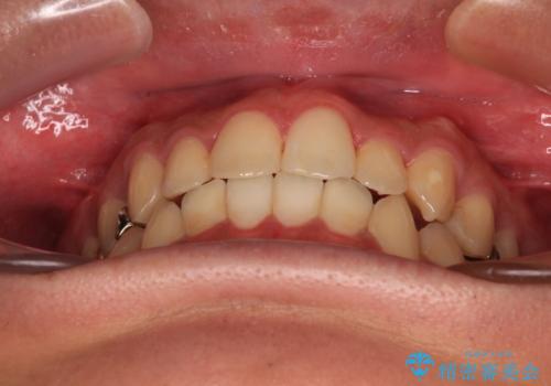 前歯のクロスバイト インビザラインによる矯正治療の治療後