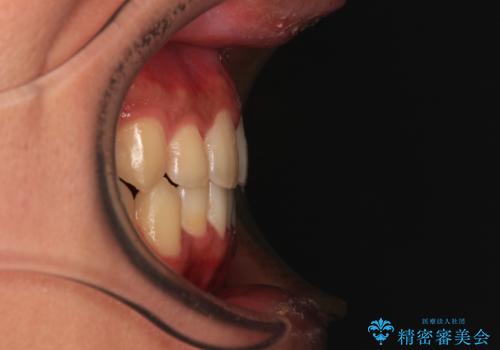 前歯のクロスバイト インビザラインによる矯正治療の治療後