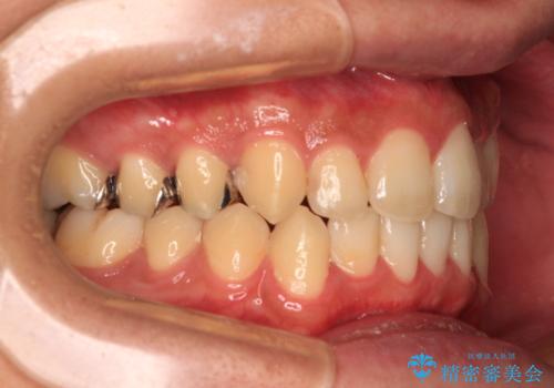 前歯のクロスバイト インビザラインによる矯正治療の治療後
