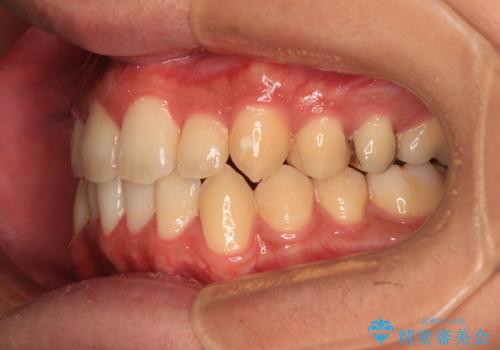 前歯のクロスバイト インビザラインによる矯正治療の治療後