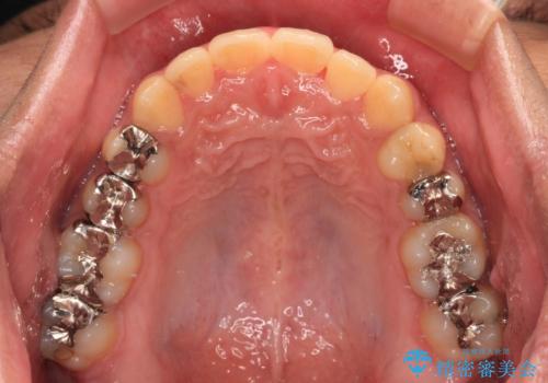前歯のクロスバイト　インビザラインによる矯正治療の治療後
