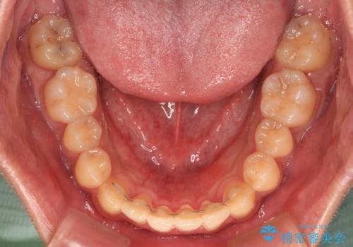前歯のクロスバイト インビザラインによる矯正治療の治療後