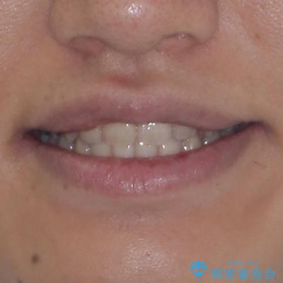 前歯のクロスバイト インビザラインによる矯正治療の治療後(顔貌)