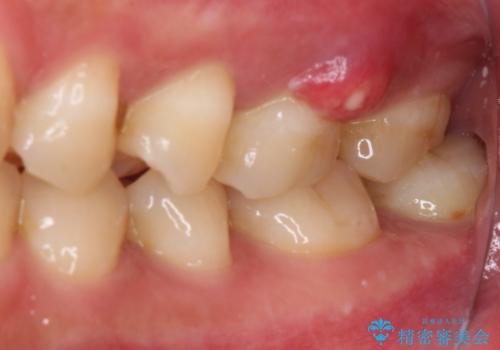 割れてしまった奥歯 サイナスリフトによるインプラント補綴治療の治療前