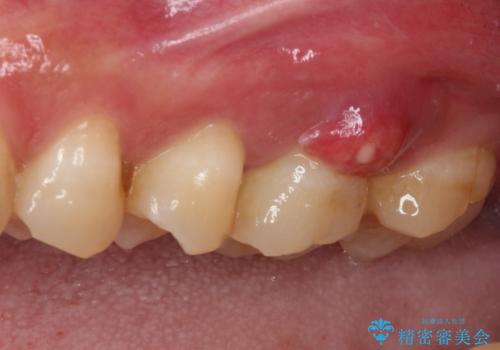 割れてしまった奥歯 サイナスリフトによるインプラント補綴治療の治療前