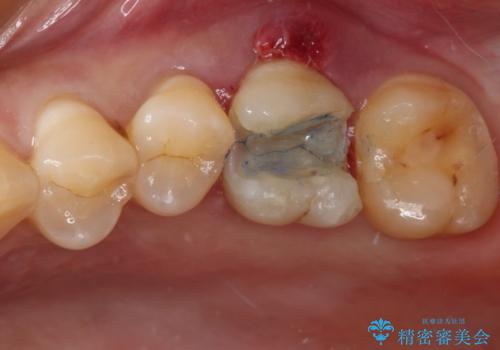 割れてしまった奥歯 サイナスリフトによるインプラント補綴治療の治療中