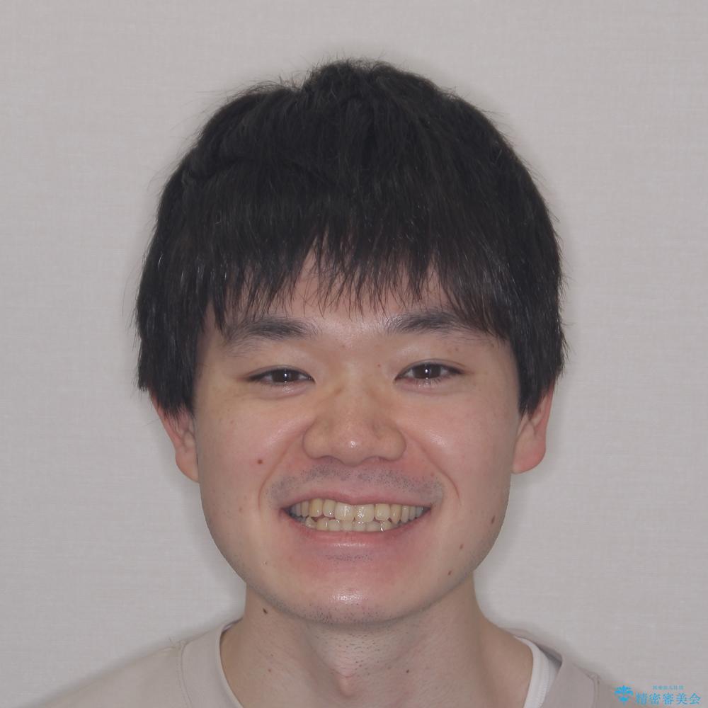 【モニター】前歯のデコボコとクロスバイト ワイヤー矯正で短期間に仕上げるの治療前(顔貌)