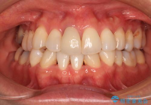 失活により変色した前歯 オールセラミッククラウンによる審美歯科治療の治療後