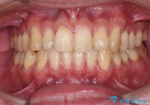 【モニター】前歯のデコボコとクロスバイト　ワイヤー矯正で短期間に仕上げるの症例 治療前