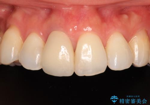 失活により変色した前歯 オールセラミッククラウンによる審美歯科治療の症例 治療後