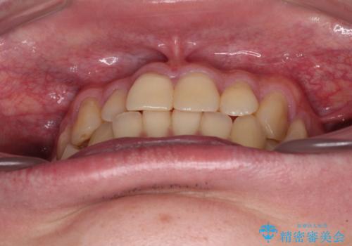 【モニター】前歯のデコボコとクロスバイト ワイヤー矯正で短期間に仕上げるの治療前