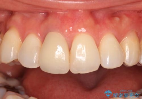 失活により変色した前歯 オールセラミッククラウンによる審美歯科治療の治療後