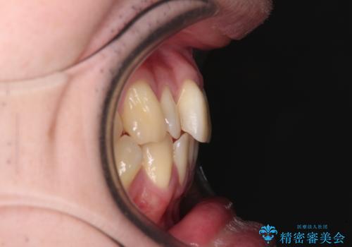 【モニター】前歯のデコボコとクロスバイト ワイヤー矯正で短期間に仕上げるの治療前