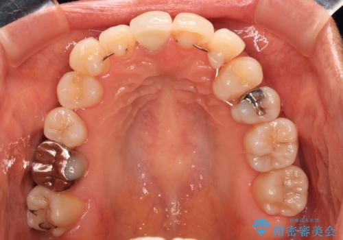 失活により変色した前歯 オールセラミッククラウンによる審美歯科治療の治療後