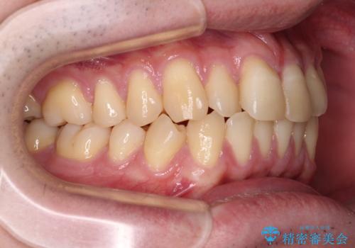 【モニター】前歯のデコボコとクロスバイト ワイヤー矯正で短期間に仕上げるの治療前