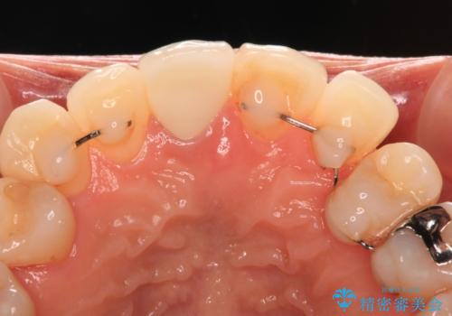 失活により変色した前歯 オールセラミッククラウンによる審美歯科治療の治療後