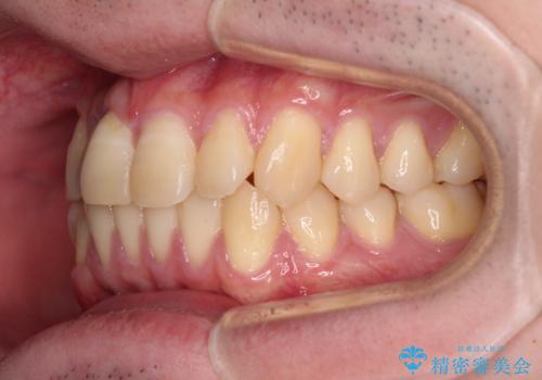【モニター】前歯のデコボコとクロスバイト　ワイヤー矯正で短期間に仕上げるの治療前