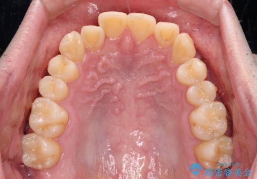 【モニター】前歯のデコボコとクロスバイト ワイヤー矯正で短期間に仕上げるの治療前
