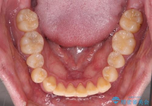【モニター】前歯のデコボコとクロスバイト ワイヤー矯正で短期間に仕上げるの治療前