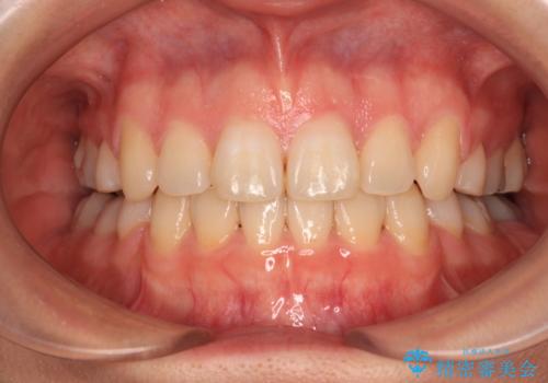 口元の突出感を抜歯矯正で改善　メタル装置で費用を抑えるの症例 治療後