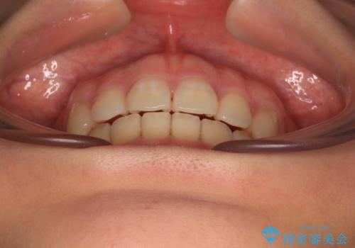 口元の突出感を抜歯矯正で改善 メタル装置で費用を抑えるの治療後