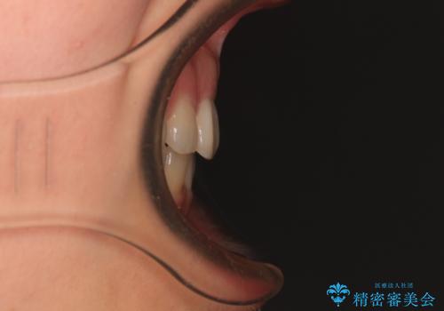 口元の突出感を抜歯矯正で改善 メタル装置で費用を抑えるの治療後