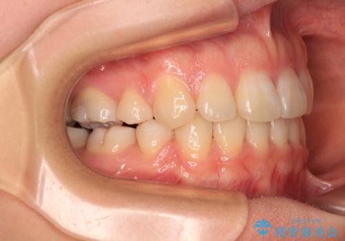 口元の突出感を抜歯矯正で改善 メタル装置で費用を抑えるの治療後