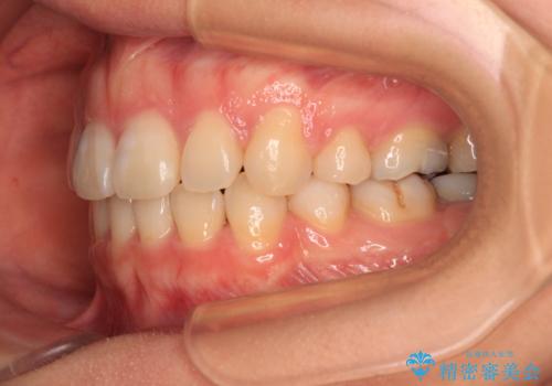 口元の突出感を抜歯矯正で改善 メタル装置で費用を抑えるの治療後