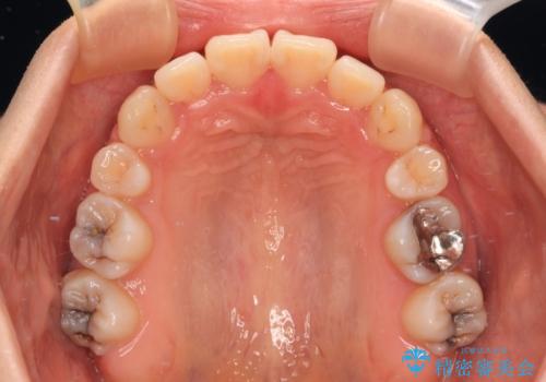 口元の突出感を抜歯矯正で改善　メタル装置で費用を抑えるの治療後