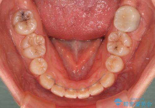 口元の突出感を抜歯矯正で改善　メタル装置で費用を抑えるの治療後