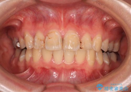 前に飛び出した前歯を治したい ワイヤー装置による抜歯矯正治療の治療後