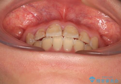 前に飛び出した前歯を治したい ワイヤー装置による抜歯矯正治療の治療後