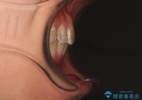 前に飛び出した前歯を治したい ワイヤー装置による抜歯矯正治療の治療後