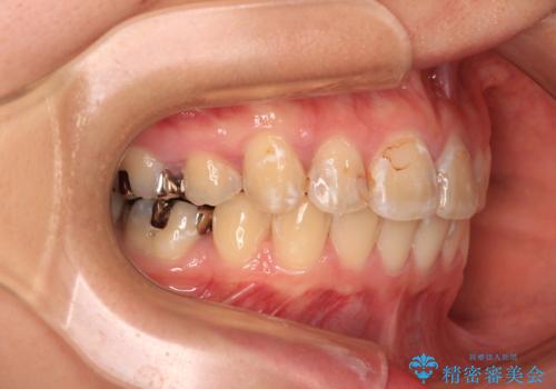 前に飛び出した前歯を治したい ワイヤー装置による抜歯矯正治療の治療後
