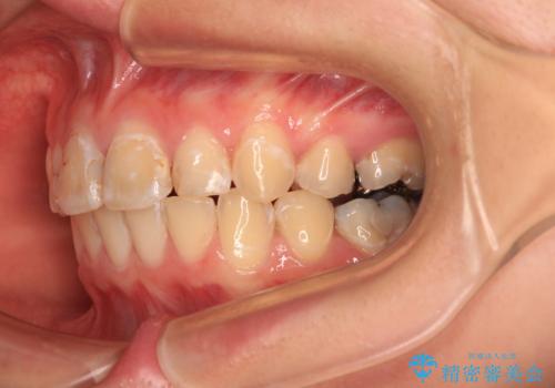 前に飛び出した前歯を治したい ワイヤー装置による抜歯矯正治療の治療後