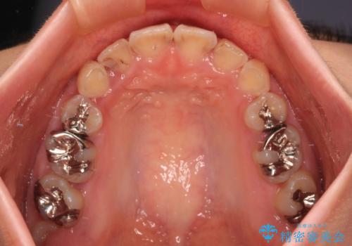 前に飛び出した前歯を治したい ワイヤー装置による抜歯矯正治療の治療後