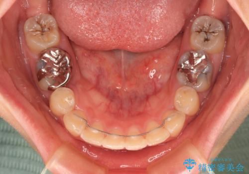 前に飛び出した前歯を治したい ワイヤー装置による抜歯矯正治療の治療後