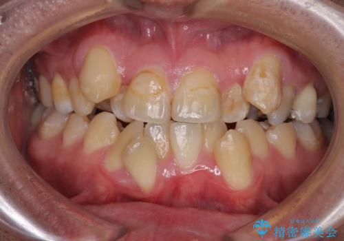 デコボコを治したい　八重歯の抜歯矯正の症例 治療前