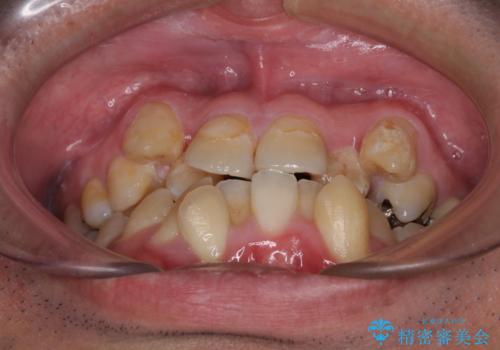 デコボコを治したい 八重歯の抜歯矯正の治療前