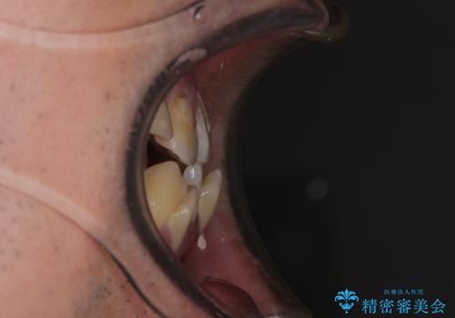 デコボコを治したい 八重歯の抜歯矯正の治療前