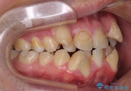 デコボコを治したい 八重歯の抜歯矯正の治療前