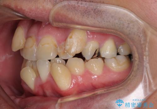 デコボコを治したい 八重歯の抜歯矯正の治療前